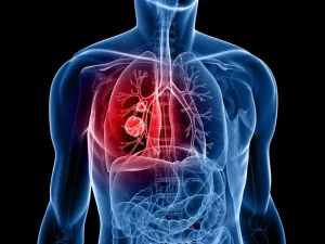Read more about the article Cancer survival rates
