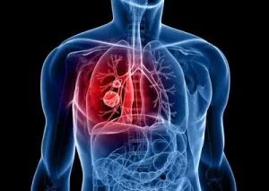 Read more about the article Cancer survival rates